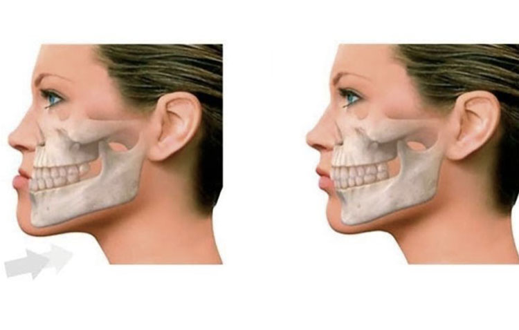 RECUO MAXILO-MANDIBULAR - CLINICA DA FACE